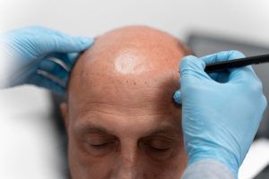 Avant de payer le prix implants capillaires, vérifiez l’expertise du chirurgien